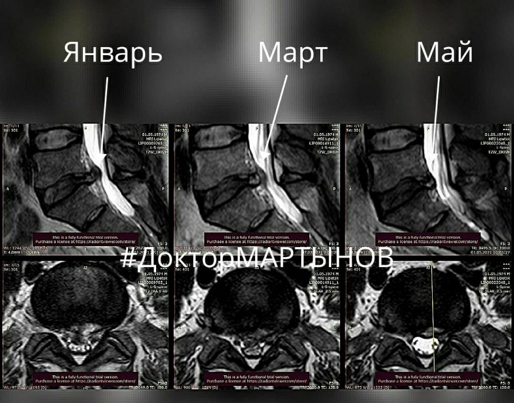 Результат резорбции грыжи на МРТ — клинический случай 2