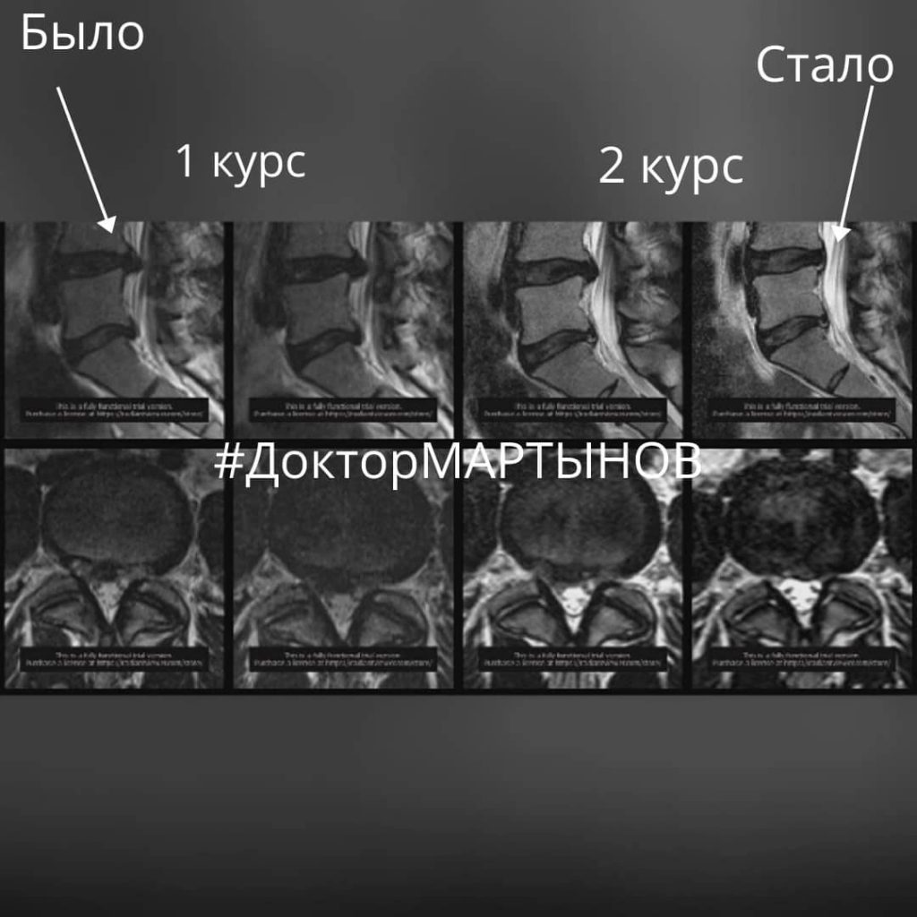 Результат резорбции грыжи на МРТ — клинический случай 5