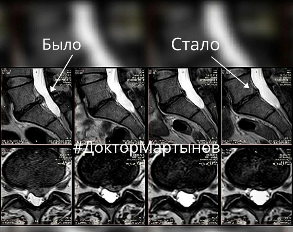 Результат резорбции грыжи на МРТ — клинический случай 7